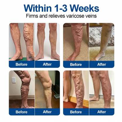 🇺🇸👨‍⚕️✅Owiwell® VeinEase Microneedle Care Patch⚡Instant Relief, Long-Term Results